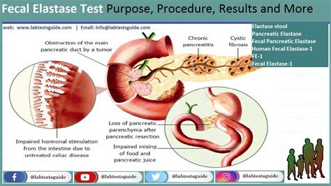 elastaza pancreatica in materii fecale|Elastază pancreatică în materii fecale